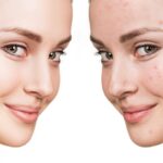 10 Home Remedies to get rid of Acne and Pimples