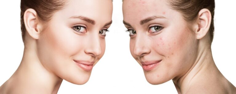 10 Home Remedies to get rid of Acne and Pimples